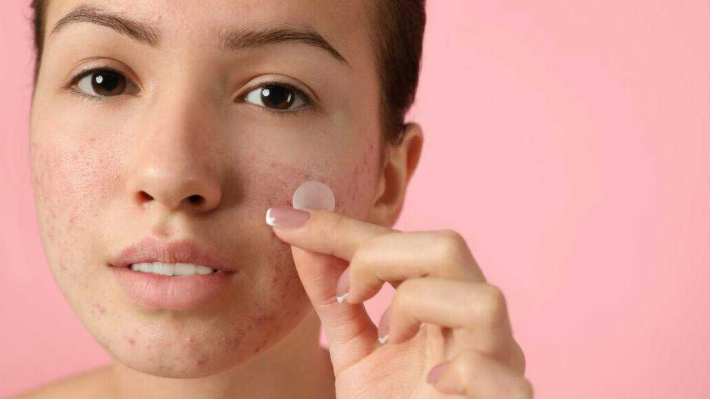 Acne Treatments, Causes, Tips and Tricks For Dealing With Acne