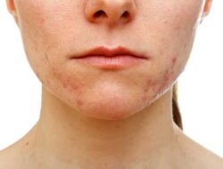 Acne Treatments, Causes, Tips and Tricks For Dealing With Acne