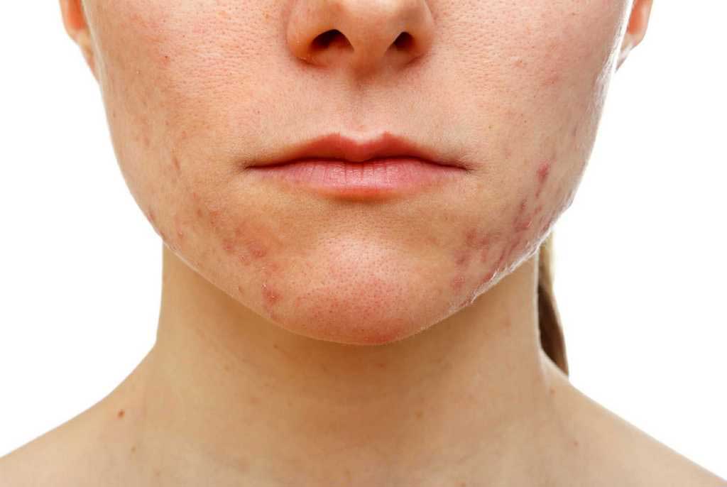 Acne Treatments, Causes, Tips and Tricks For Dealing With Acne