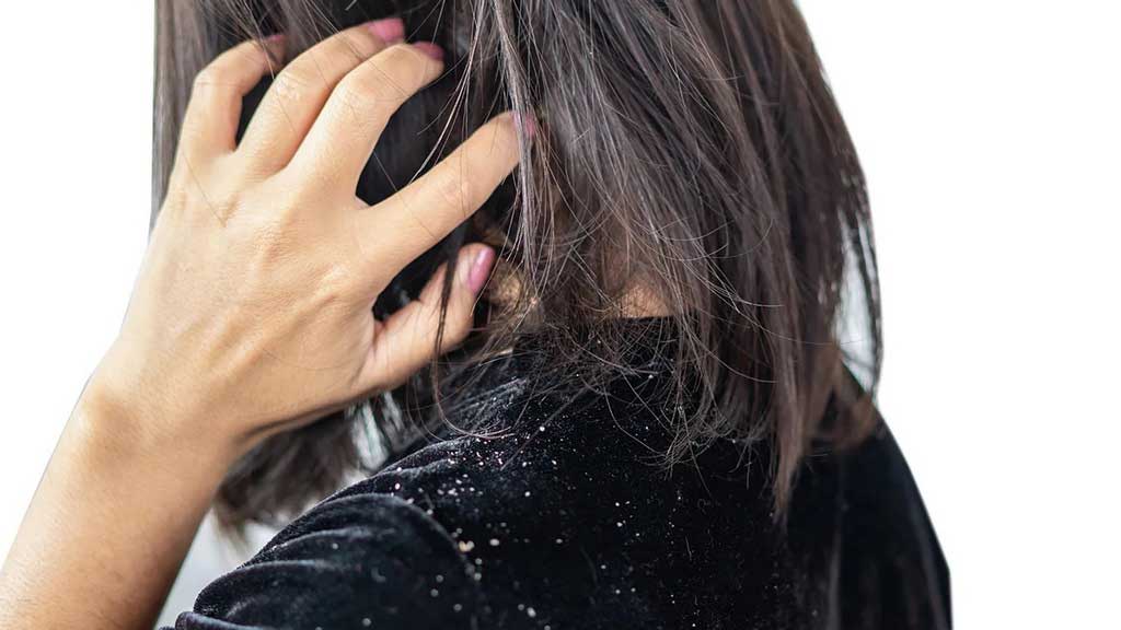 Dandruff Facts, Myth, And Major Understanding You Should Know