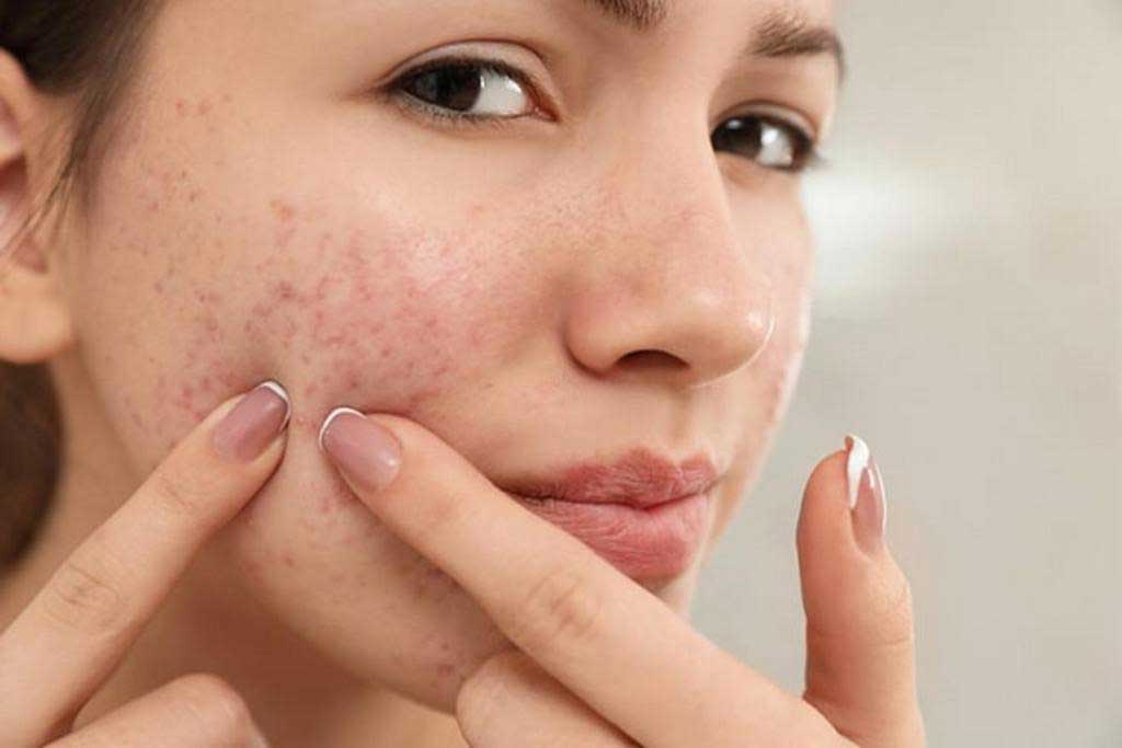 Get To Know More About Acne! The Cause, Types, And How To Clear It Up