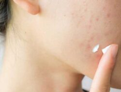 Acne Problem You Should Know! The Cause, Types, And How To Clear It Up