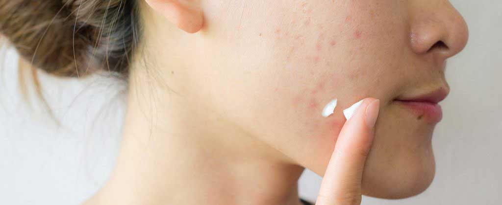 Get To Know More About Acne! The Cause, Types, And How To Clear It Up