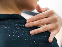 Is It Severe Dandruff Or Something Else? The Sign And Other Possible Conditions