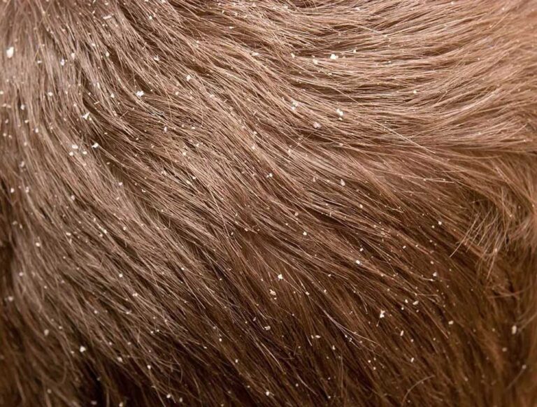 5 Severe Dandruff Causes And The Remedy To Know - Personal Care Magazine