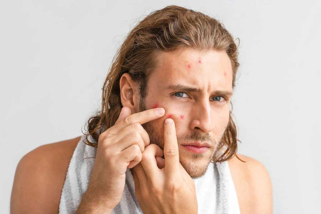 Different Types Of Acne And The Best Ways To Treat Them