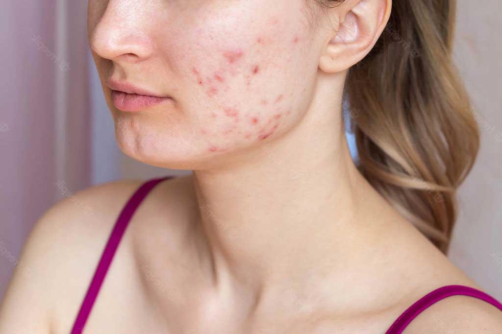 Different Types Of Acne And The Best Ways To Treat Them