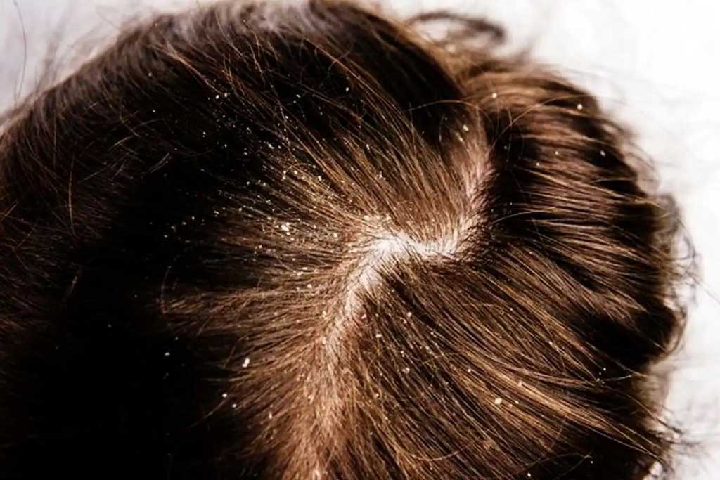 Is It Severe Dandruff Or Something Else? The Sign And Other Possible Conditions