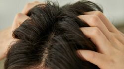 The 5 Severe Dandruff Causes And The Remedy To Know