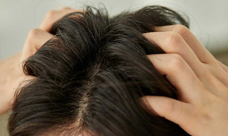 5 Severe Dandruff Causes And The Remedy To Know - Personal Care Magazine