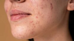 Acne Scar You Should Know! The Types, Severity, And Its Remedies