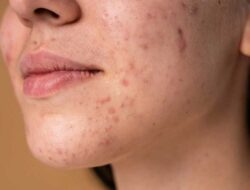 Acne Scars You Should Know! The Types, Severity, And Its Remedies