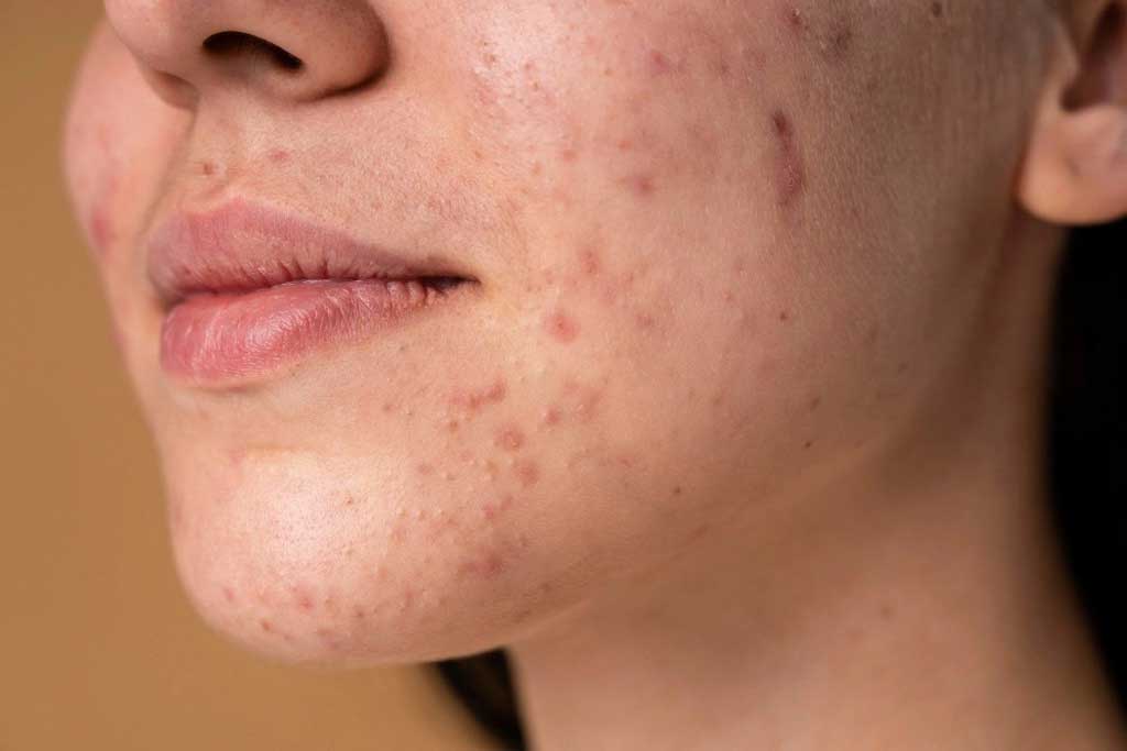 Acne Scar You Should Know! The Types, Severity, And Its Remedies