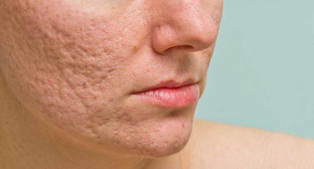 Acne Scars You Should Know! The Types, Severity, And Its Remedies