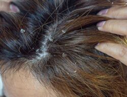 4 Must-Try Natural Severe Dandruff Removal to Get Rid of Dandruff