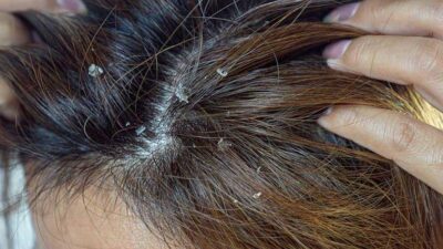 4 Must-Try Natural Severe Dandruff Removal to Get Rid of Dandruff