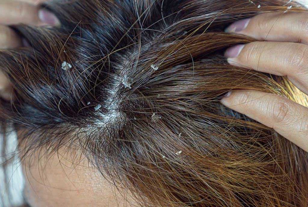 4 Must-Try Natural Severe Dandruff Removal to Get Rid of Dandruff