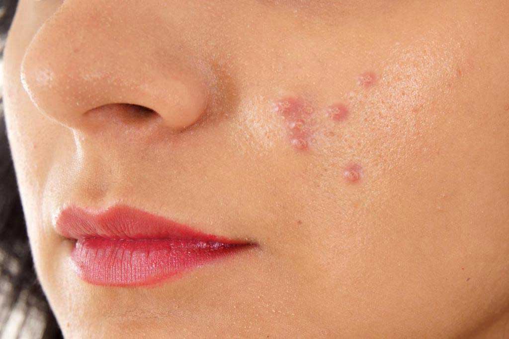 Different Types of Acne on the Face and How to Treat Them