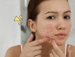 Different Types of Acne on the Face and How to Treat Them