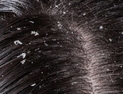 Dandruff Remedy At Home with Natural Treatments