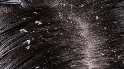 Dandruff Remedy At Home with Natural Treatments