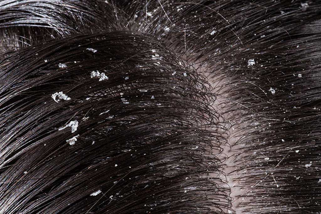 Dandruff Remedy At Home with Natural Treatments