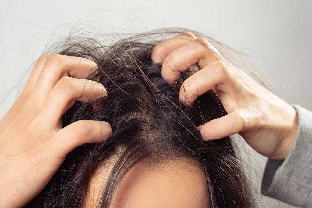 Dandruff Remedy At Home with Natural Treatments