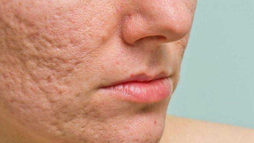 5 Different Types of Acne Scars and How To Treat Them