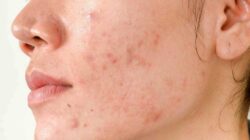 5 Different Types of Acne Scars and How To Treat Them