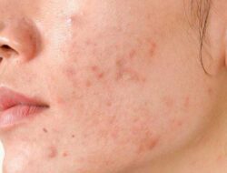 5 Different Types of Acne Scars and How To Treat Them