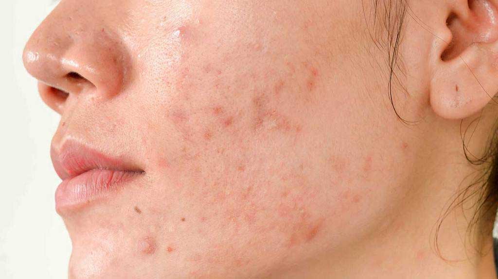 5 Different Types of Acne Scars and How To Treat Them - Personal Care ...