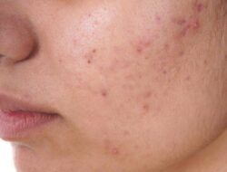 Mild Acne Treatments You Can Try To Get Rid of Mild Acne