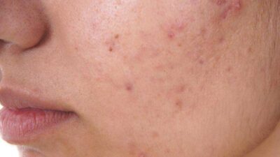 Mild Acne Treatments You Can Try To Get Rid of Mild Acne