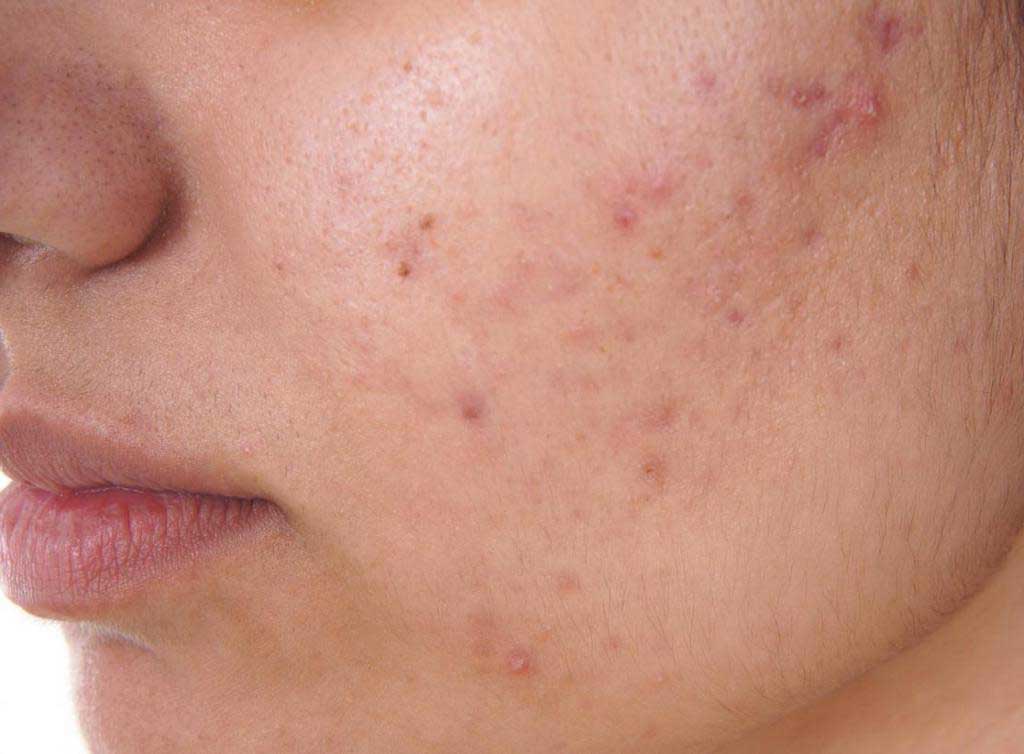 Mild Acne Treatments You Can Try To Get Rid of Mild Acne