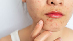 How To Get Rid Of Period Acne? The Cause And Guide To Deal With It!