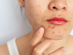 How To Get Rid Of Period Acne? The Cause And Guide To Deal With It!