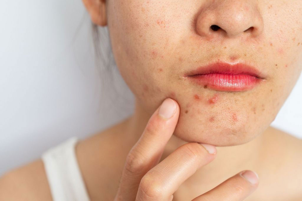 How To Get Rid Of Period Acne? The Cause And Guide To Deal With It!