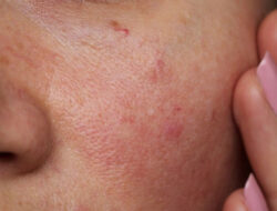 Itchy Acne On Face! How to Treat The Pesky Skin Inflammation?