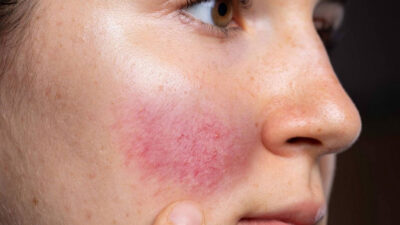 5 Vitamins For Rosacea! Know Your Skin Condition And Care!