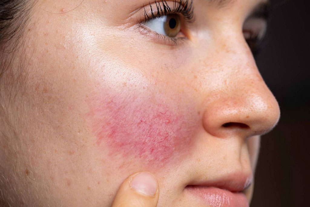 5 Vitamins For Rosacea! Know Your Skin Condition And Care!