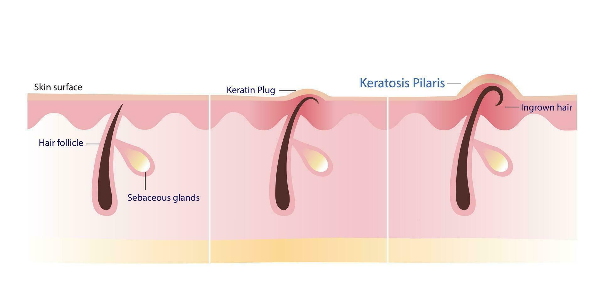 Ever wondered why your hair sometimes feels coarse or appears uneven? Enter keratin plugs! These tiny formations in hair follicles can hold the key to understanding your hair's health and texture. Let’s dive into the fascinating world of keratin plugs and uncover their secrets!