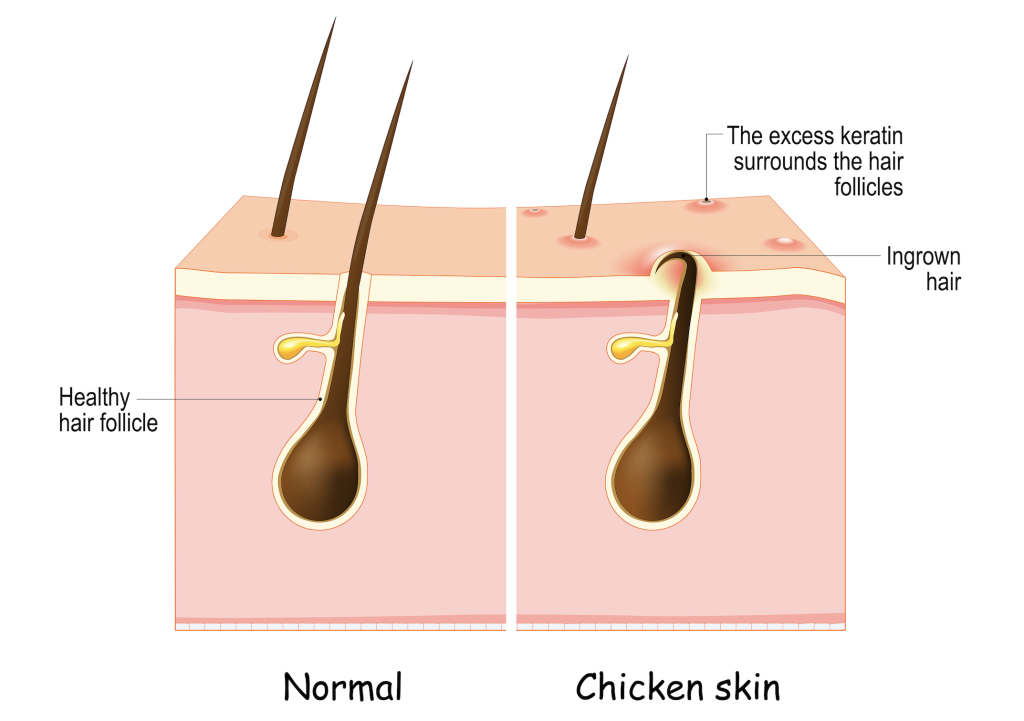 Have you ever noticed unusual bumps on your scalp or changes in your hair texture? You might be dealing with keratin plugs! These intriguing little formations play a significant role in hair health. Join us as we unravel the mysteries of keratin plugs in hair follicles!